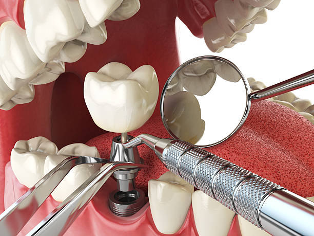 Best Emergency Treatment for Dental Infections or Abscesses in West Point, NY